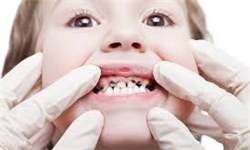مواد قندی دهان را اسیدی می‌کند/ حل شدن دندان‌ها در فضای اسیدی