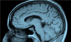 برداشتن تومور مغزی بدون استفاده از بیهوشی / تکلم بیمار هنگام انجام عمل جراحی مغز