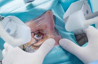 جراحی موفق آب‌مروارید زوج سالمند در ایرانمهر سراوان